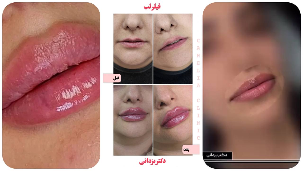 تزریق لب در کرج