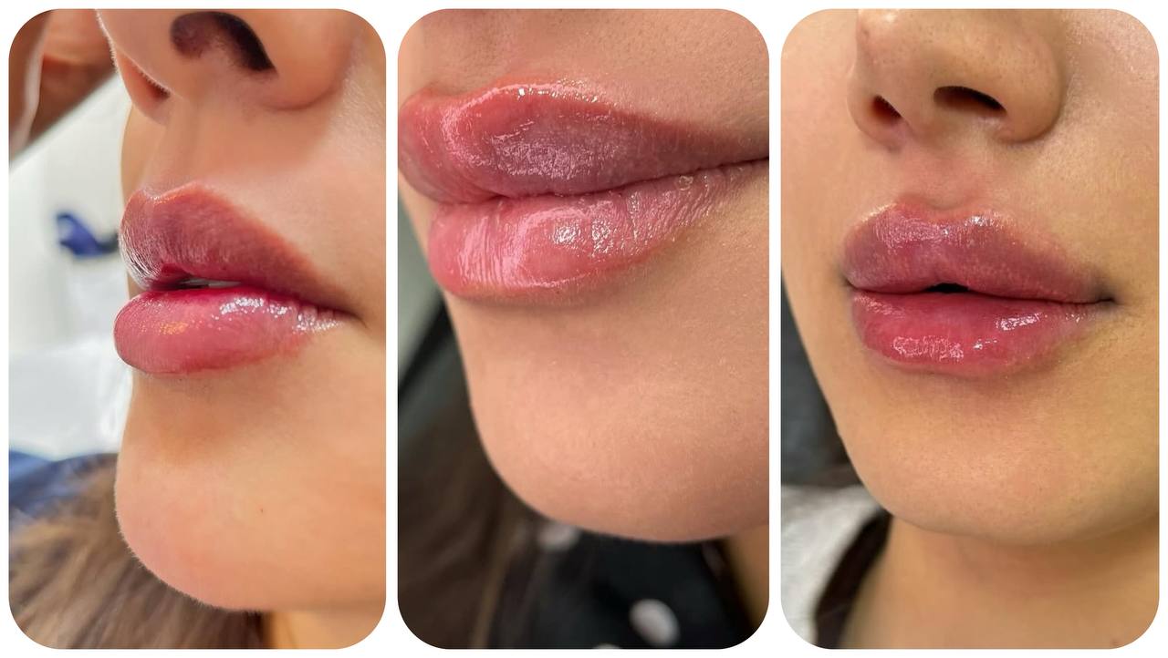 تزریق لب کرج