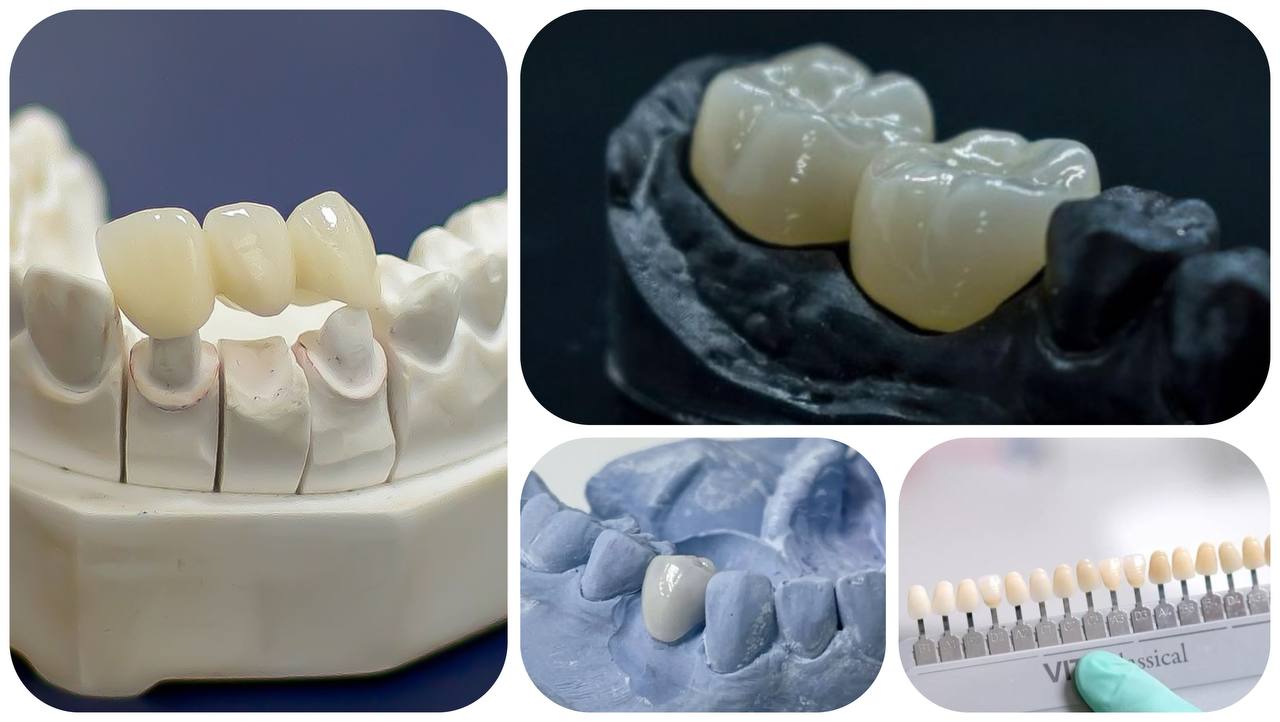 روکش دندان در کرج