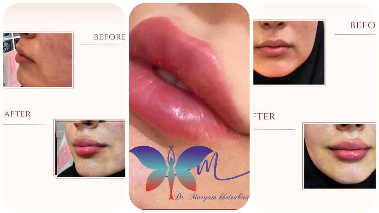 کلینیک تزریق لب در کرج